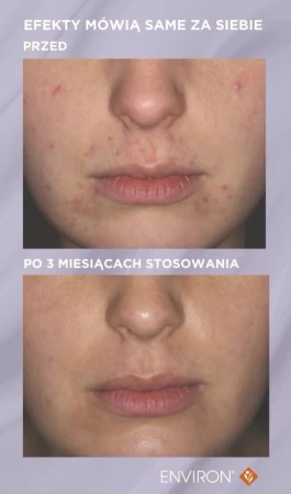 Dwa zdjęcia tej samej damskiej twarzy  jedno pod drugim, ukazujące efekt przed terapią Environ Clarity i po niej.