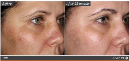 2 zdjęcia ze zbliżeniem na skórę twarzy kobiety przed i po stosowaniu produktów z linii Environ Focus Care Radiance.