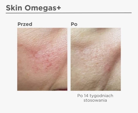 Porównanie skóry przed i po 14 tygodniach stosowania Skin Omegas+. Po lewej stronie widoczne zaczerwienienia i przesuszenie, po prawej gładsza, lepiej nawilżona skóra bez zaczerwienień.