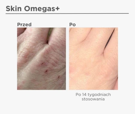 Porównanie skóry dłoni przed i po 14 tygodniach stosowania suplementu Skin Omegas+. Lewa strona ukazuje przesuszoną skórę z uszkodzeniami, prawa – gładką, nawilżoną skórę o jednolitym kolorycie.