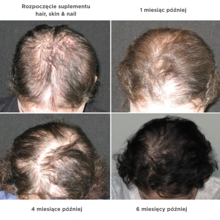 Cztery zdjęcia z góry przedstawiające postępy wzrostu włosów: start kuracji, po 1, 4 i 6 miesiącach suplementacji Hair, Skin & Nail – widoczne zagęszczenie i poprawa wyglądu włosów w kolejnych etapach.