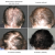 Cztery zdjęcia z góry przedstawiające postępy wzrostu włosów: start kuracji, po 1, 4 i 6 miesiącach suplementacji Hair, Skin & Nail – widoczne zagęszczenie i poprawa wyglądu włosów w kolejnych etapach.